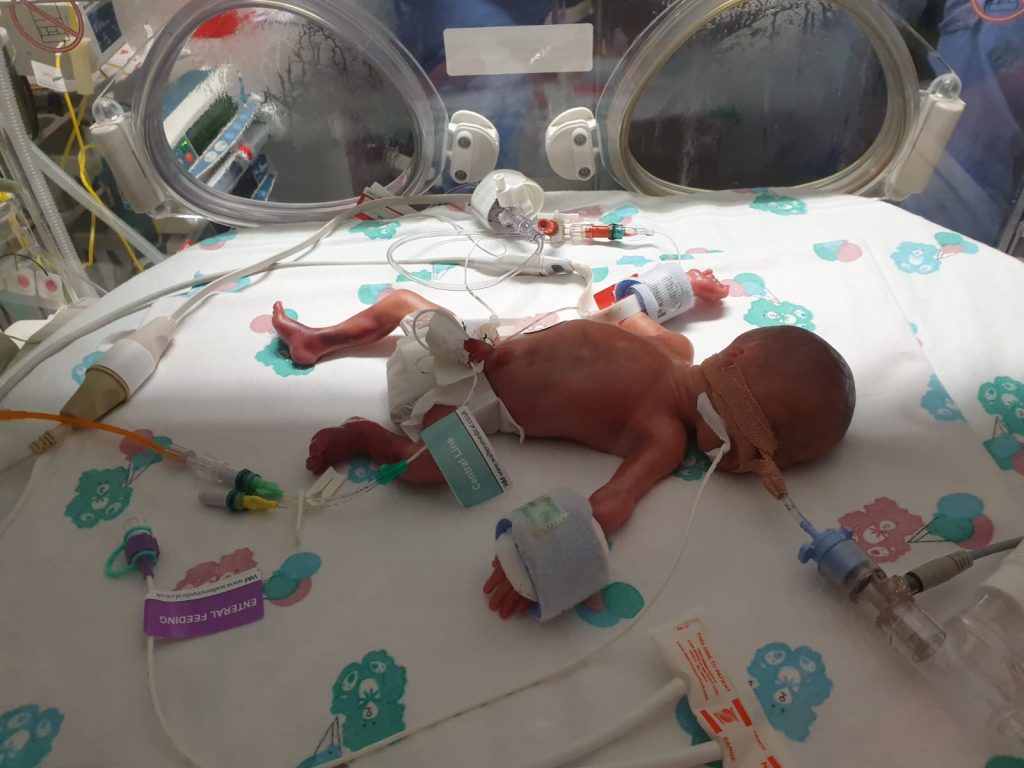 Baby Eliza receiving donor milk in hospital