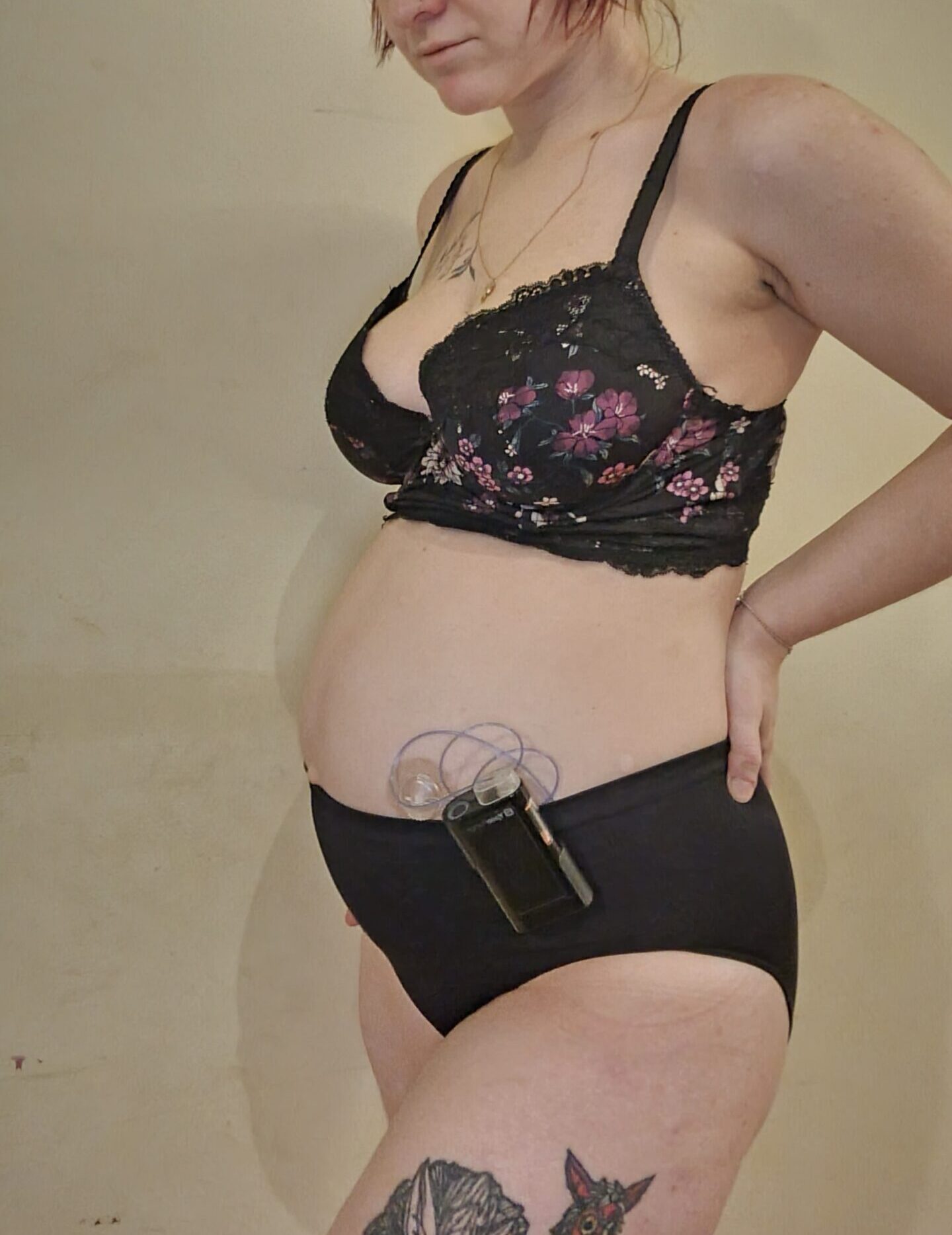 pregnant and diabetic, Sophie Nichols