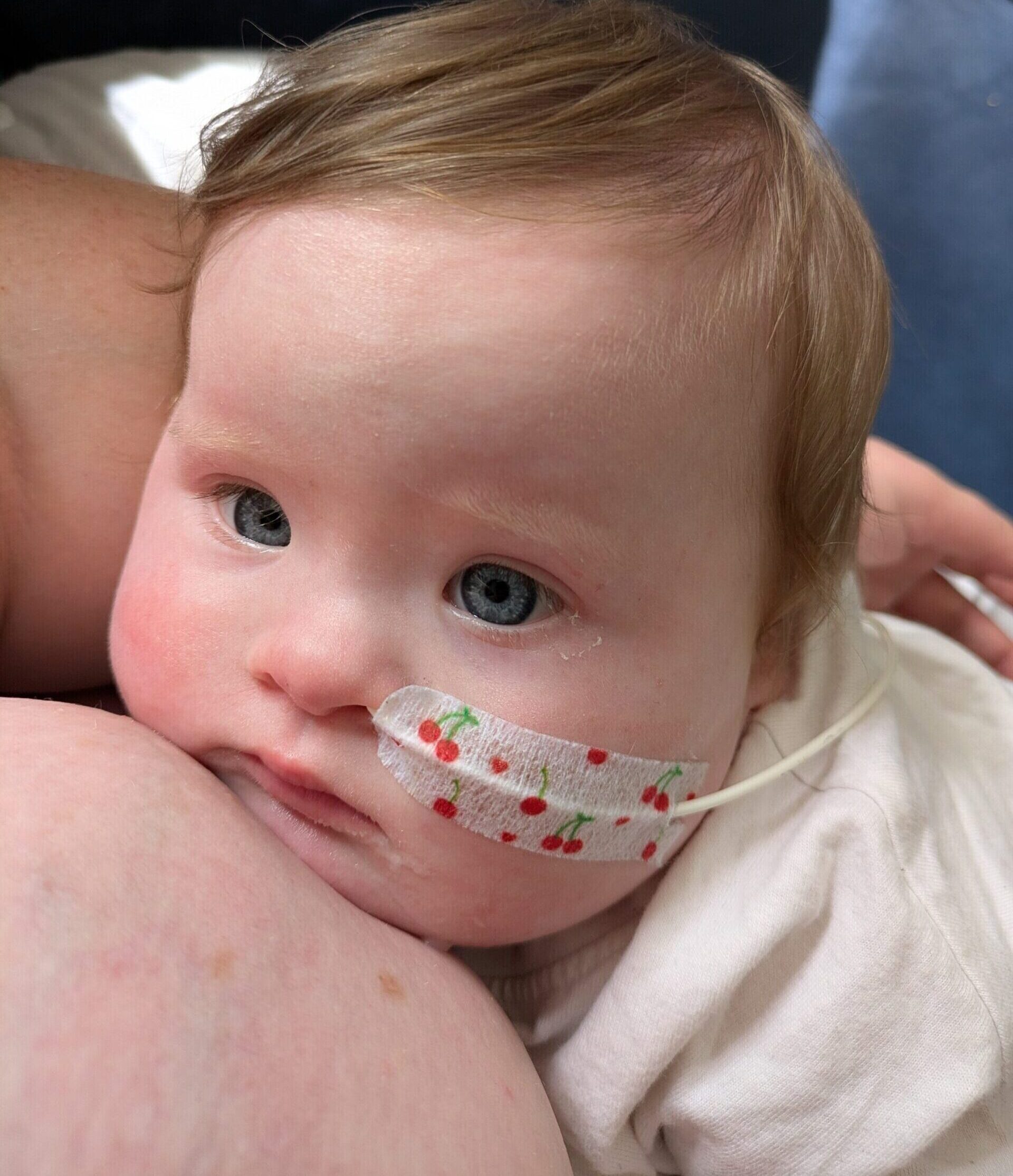 baby Ivy with down syndrome who uses an ng tube
